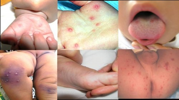 Vết loét trong miệng bé
